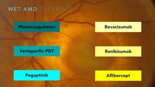 Wet Macular Degeneration