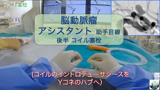 脳動脈瘤コイル ｱｼｽﾀﾝﾄ 後半 コイル塞栓