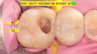 Conservatively Treating Large Cavities with Composite Restorations | Avoiding RCT \u0026 Crowns