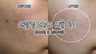 새살침 효과있나요? 시간 지나면 흉터 꺼지나요? 코라테라피 새살침 6회차 후기 / 여드름 패인흉터 없애기