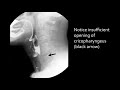 Swallowing disorders - Aspiration due to stasis (2)