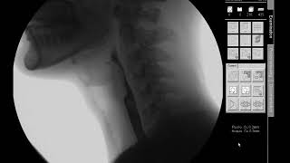 Nectar Thick Liquids - Modified Barium Swallow Study (MBSS) Lateral View HD