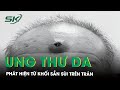 Phát Hiện Ung Thư Da Từ Khối Sần Sùi Trên Trán | SKĐS