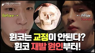 휜코는 교정해도 재발한다?? 절대로 재발하지 않습니다. @@인 경우만 빼고! #코성형 전 필수시청!!