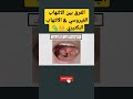 ايه الفرق بين التهاب اللوز الفيروسى و التهاب اللوز البكتيرى ؟ 🤒🦠 shorts