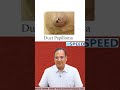 duct ectasia by dr.k.vinayak senthil. neetss iniss medico neetpg