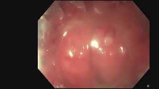 Endoscopic Management of Symptomatic Pseudodiverticulum After Esophagectomy