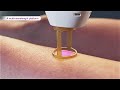 Laser hair removal - GentleMax Pro Plus (3D medical device animation)