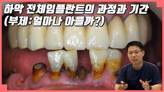 [대전 투명교정, 대전 임플란트] 하악 전체 임플란트의 과정과 기간(부제:얼마나 아플까?)