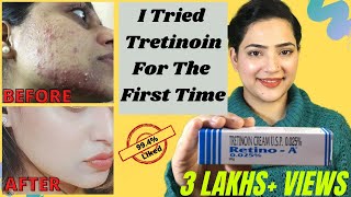 Retino A 0.025%cream Review | Before And After Tretinoin Cream Review | My experience with Tretinoin