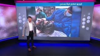 جراح صيني ينشر فيديو صادم لرئة مدخن لـ30 عاما