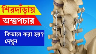 শিরদাঁড়ায় অস্ত্রপচার কখন করা হয়ে, কেন করা হয় এবং কিভাবে করা হয় জানতে চোখ দেখুন এই পর্বটি।