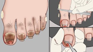 ASMR ingrown toenail removal animation | ASMR foot treatments