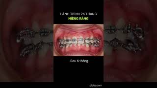 Quá trình niềng răng 26 tháng #braces #dentist