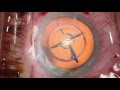 Cataract Surgery with the Proveo 8 Ophthalmic Microscope