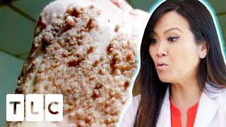 "I've Never Seen Quite An Extensive Case As This!" | Dr. Pimple Popper: Before The Pop
