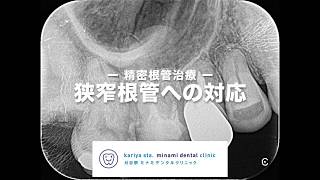 精密根管治療 　【愛知県刈谷市の歯医者】　狭窄根管　１回で終わる　One Visit Root Canal Therapy　バイオセラミックス　自由診療　顕微鏡歯科　マイクロスコープ　Kariya