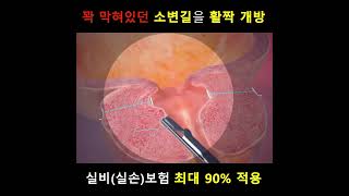 꽉 막혀있던 소변길을 활짝 개방