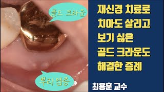 1회 재신경 치료로 치아 살리고 세라믹 치료한 증례 #치아살리기 #판교최용훈치과 #플라젠 #판교최용훈치과