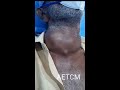 a 64 yr old male with neck swelling presented with hoarseness of voice