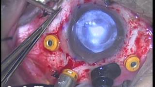 Argus II - Retinal Implant - Bionic Eye Dr. Fernando Arevalo First Argus II Surgery in Middle East