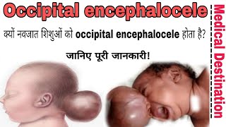 Occipital encephalocele | causes | symptoms | treatment in hindi | medical Destination |