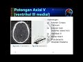 Teknik Pemeriksaan CT Scan Kepala