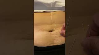 Chinese medicine acupuncture cured sciatica pain in few minutes without side effects.