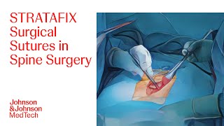 Spine Surgery with STRATAFIX Surgical Sutures and DERMABOND PRINEO Skin Closure System | J\u0026J MedTech