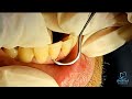 Manual Teeth Scaling _ Demo for dental student