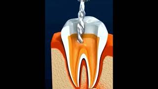 How Root canal Treatment works