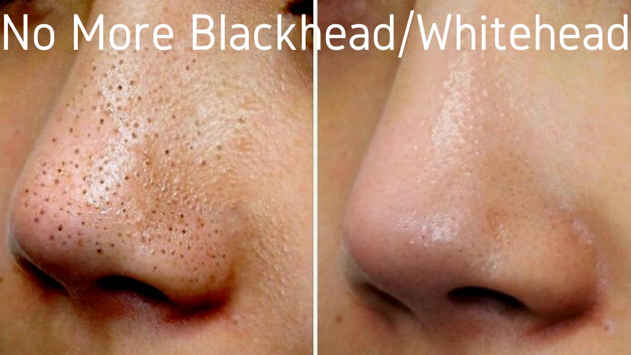 Best Blackhead/Whitehead Treatment| How To Remove Blackhead| HipHop ...