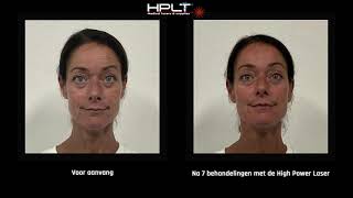 Fijne lijntjes en rimpels verminderen en huidtextuur en huidskleur verbeteren met HPLT Lasertherapie