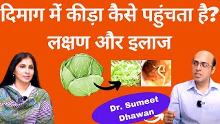 पत्तागोभी से कैसे दिमाग में कीड़ा पहुंचता है?Neurocysticercosis/Parasitic infection|Dr.Sumeet Dhawan