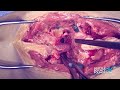 surgical demo intra discal osteotomy ido rod j. oskouian jr m.d.