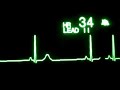 #ECGwaves in Sinus bradycardia /SENTHAMIL 24*7 TV CHANNEL