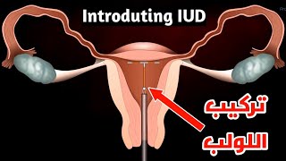 شاهد ازاي بيتم تركيب لولب منع الحمل_IUD insertion steps