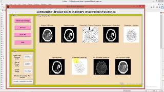 Brain Tumor Detection Using Watershed Technique Matlab Project Code