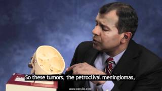 Petroclival Meningioma with Subtitles