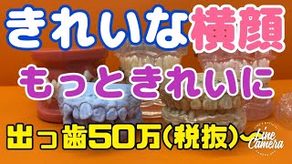 321)出っ歯＋八重歯を少ない本数で抜歯矯正で1年〜1年半　白いワイヤー矯正　マウスピース矯正不可の症例　費用45-50万(税抜)