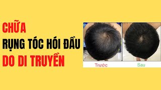 Chữa Rụng Tóc Hói Đầu Di Truyền #5