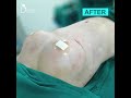 sebbin breast implant breast augmentation surgery with silicone implant plastic surgery india