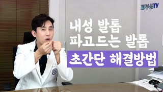 3분피부꿀팁! 내성발톱 제거 초간단 치료방법