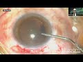 glaucoma taming the monster challenging cataract surgery prof. yehia salah