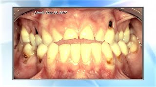 Drs. Checkup: Ex-Bulimic Guest Gets Brand New Smile! Banning “Best Friends” in Schools? Docs Disc…