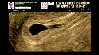 Kehamilan 6 minggu dgn hematom subchorionic