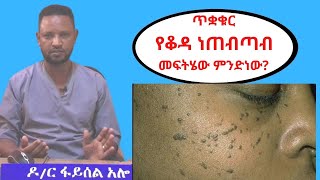 ይህ ጥቋቁር የቆዳ  ነጠብጣብ መፍትሄው ምንድነው? Dermatosis Papulosa Nigra (DPN) in Amharic - Dr. Feysel on Tenaseb