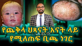 የጨቅላ ህጻናት አናት ላይ የሚለጠፍ ቢጫ ነገር ምንድን ነው ? ምክንያትና መፍትሄዎችሁ | cradle cup |