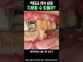 역대급 치아 상태의 환자분 등장 #shorts