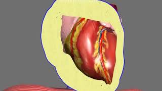 Pericardiocentesis in Pericardial Effusion and Cardiac Tamponade Animation by Cal Shipley, M.D.